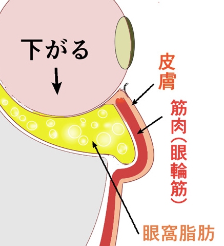 newaリフト 目の下たるみ